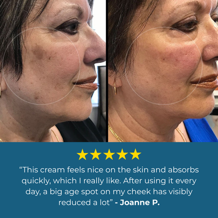 Aloria Age Spot Cream™