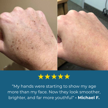 Aloria Age Spot Cream™