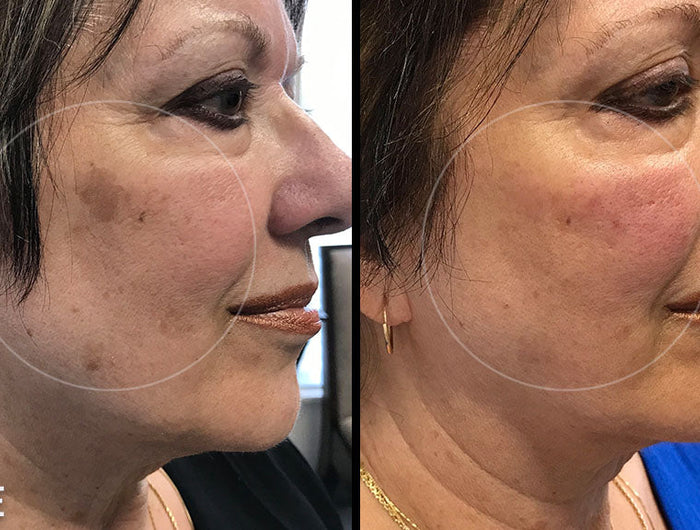 <h2>Prevent New Age Spots From Forming</h2>